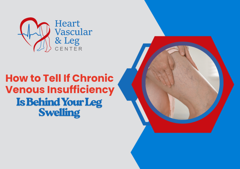 How to Tell If Chronic Venous Insufficiency Is Behind Your Leg Swelling