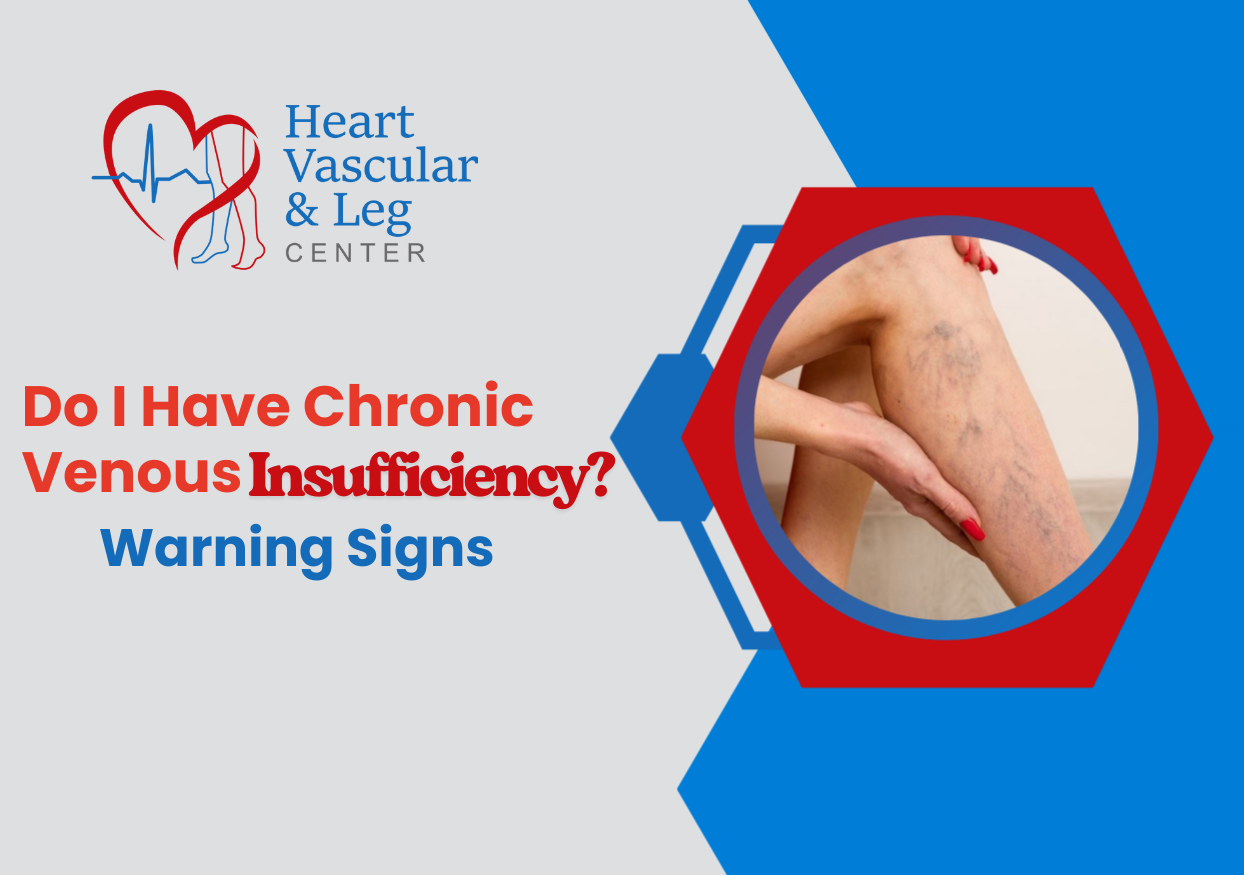 Do I Have Chronic Venous Insufficiency? Warning Signs