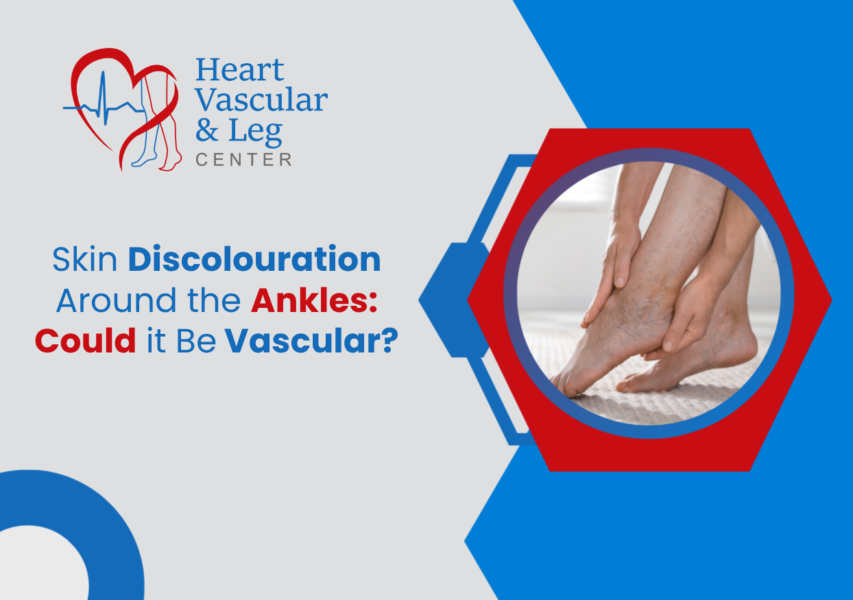 Skin Discolouration Around the Ankles: Could it Be Vascular?