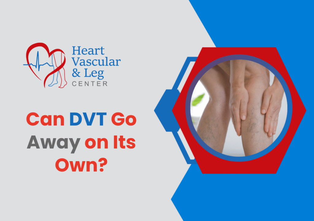 Can DVT Go Away on Its Own?