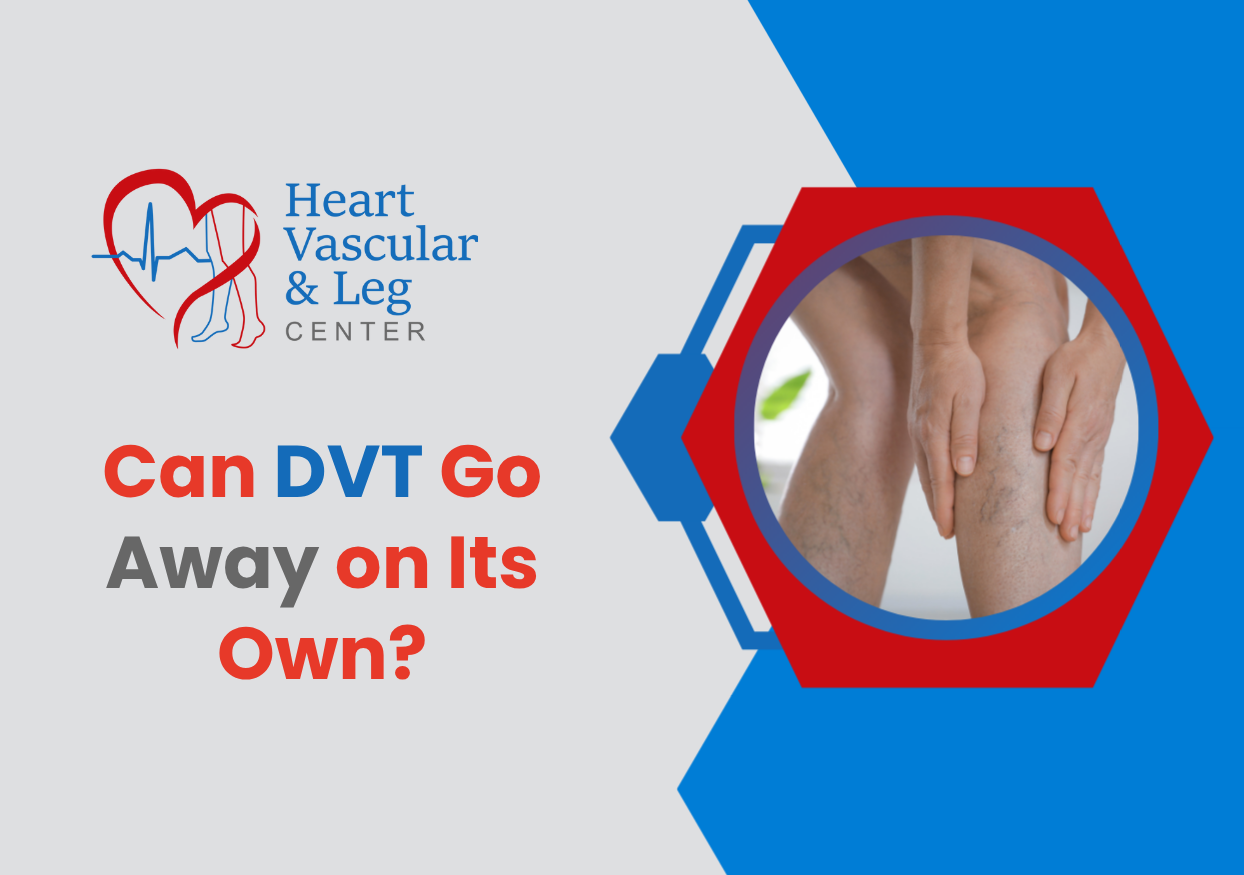 Can DVT Go Away on Its Own?