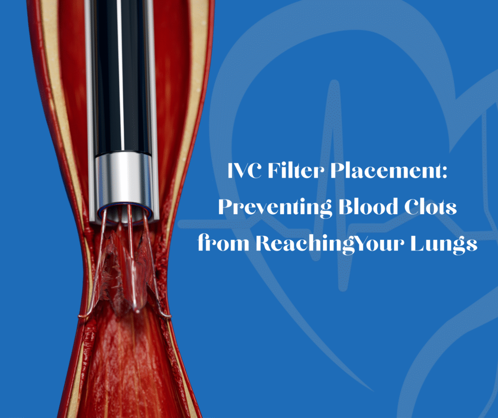 IVC Filter Placement: Preventing Blood Clots from Reaching Your Lungs