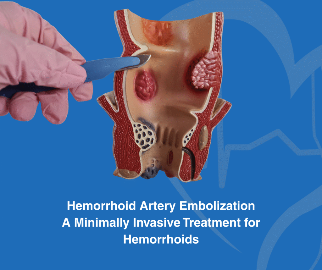 Hemorrhoid Artery Embolization : A Minimally Invasive Treatment for Hemorrhoids