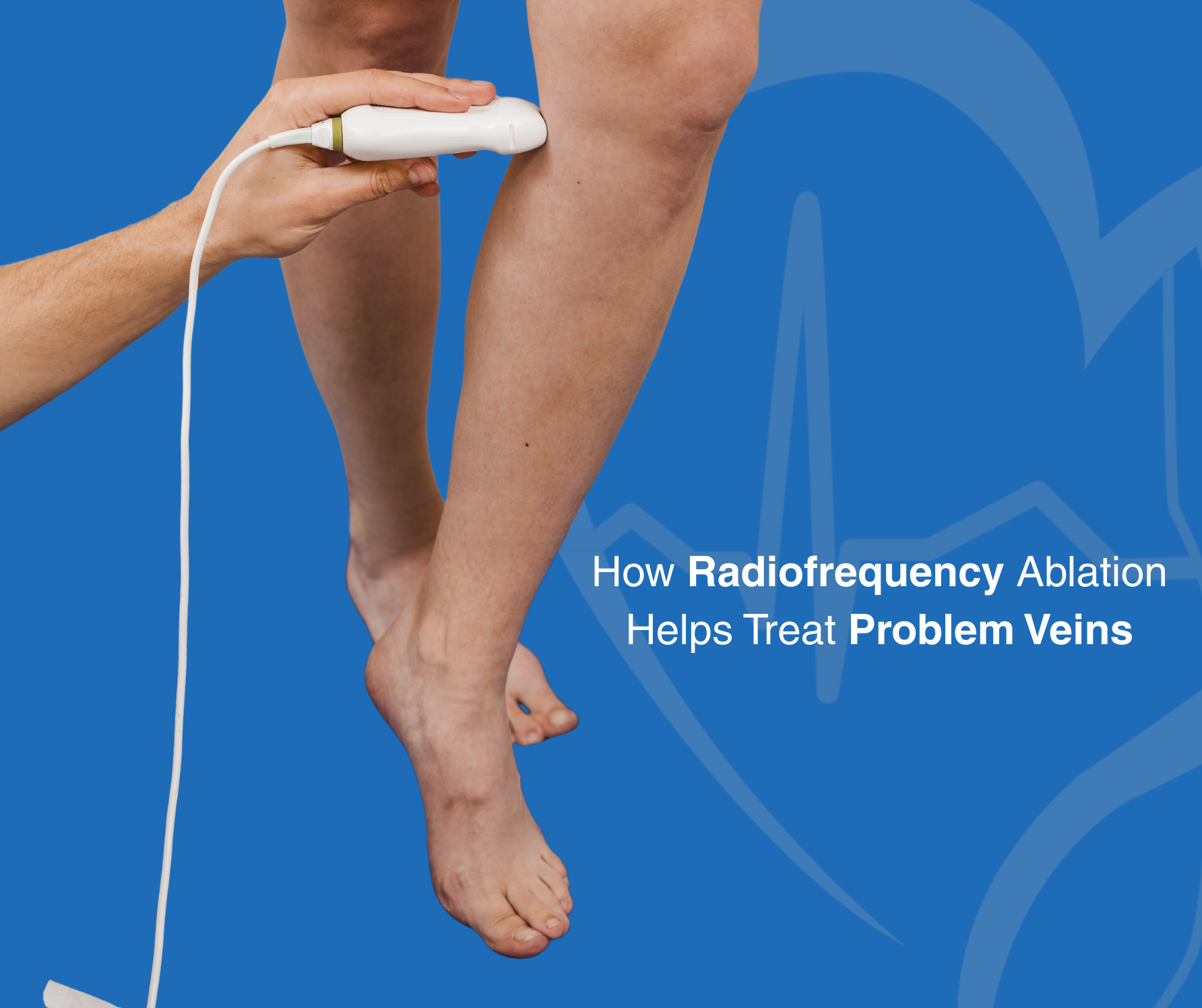 How Radiofrequency Ablation Helps Treat Problem Veins