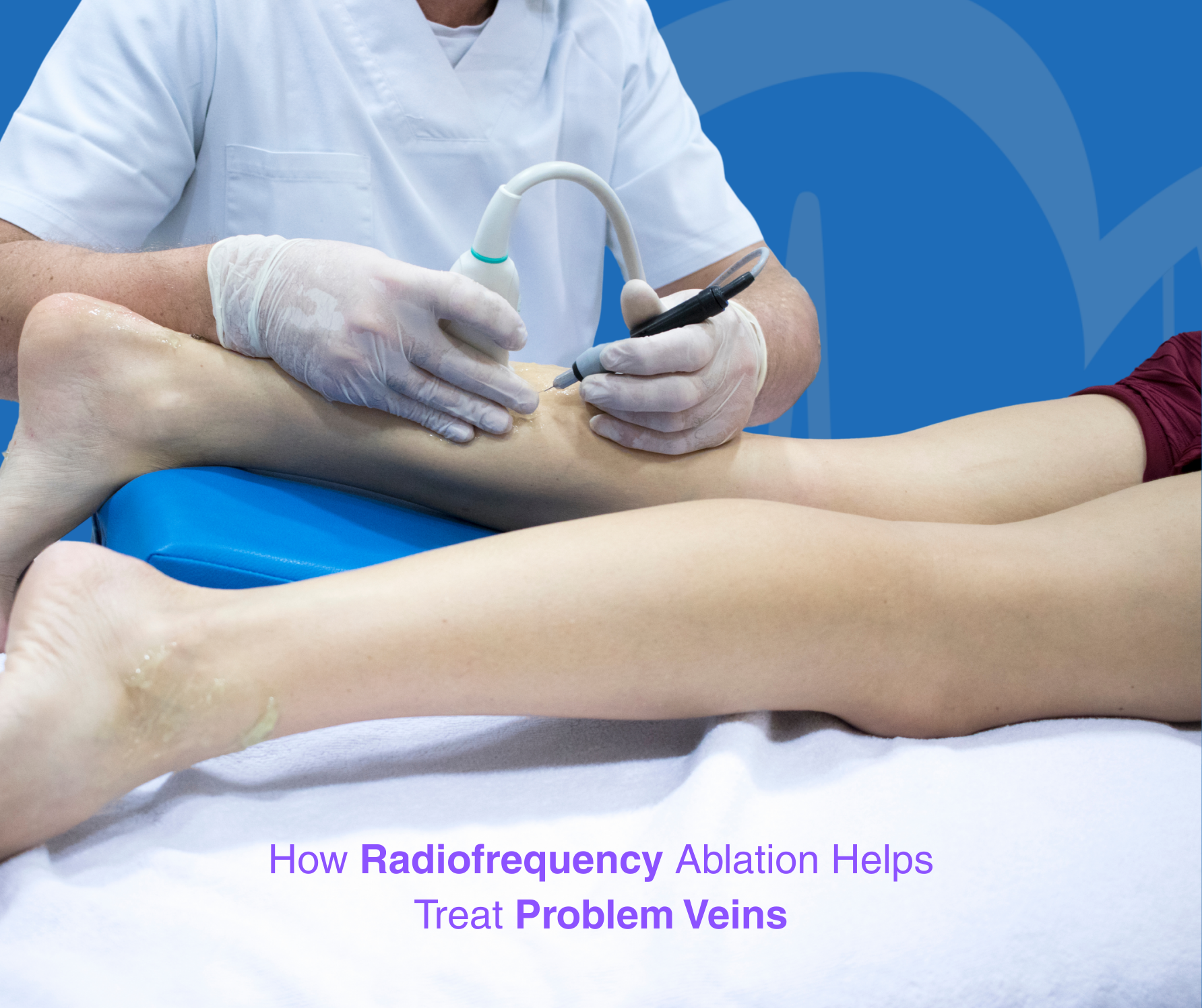 How Radiofrequency Ablation Helps Treat Problem Veins