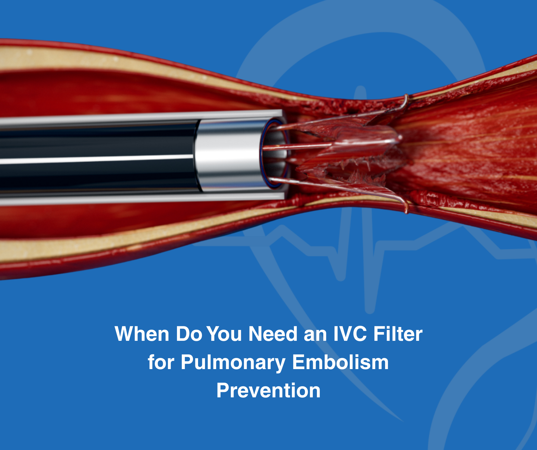 When Do You Need an IVC Filter for Pulmonary Embolism Prevention