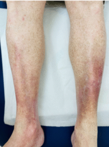 Does Leg Discoloration Mean a Vascular Condition Is Starting?