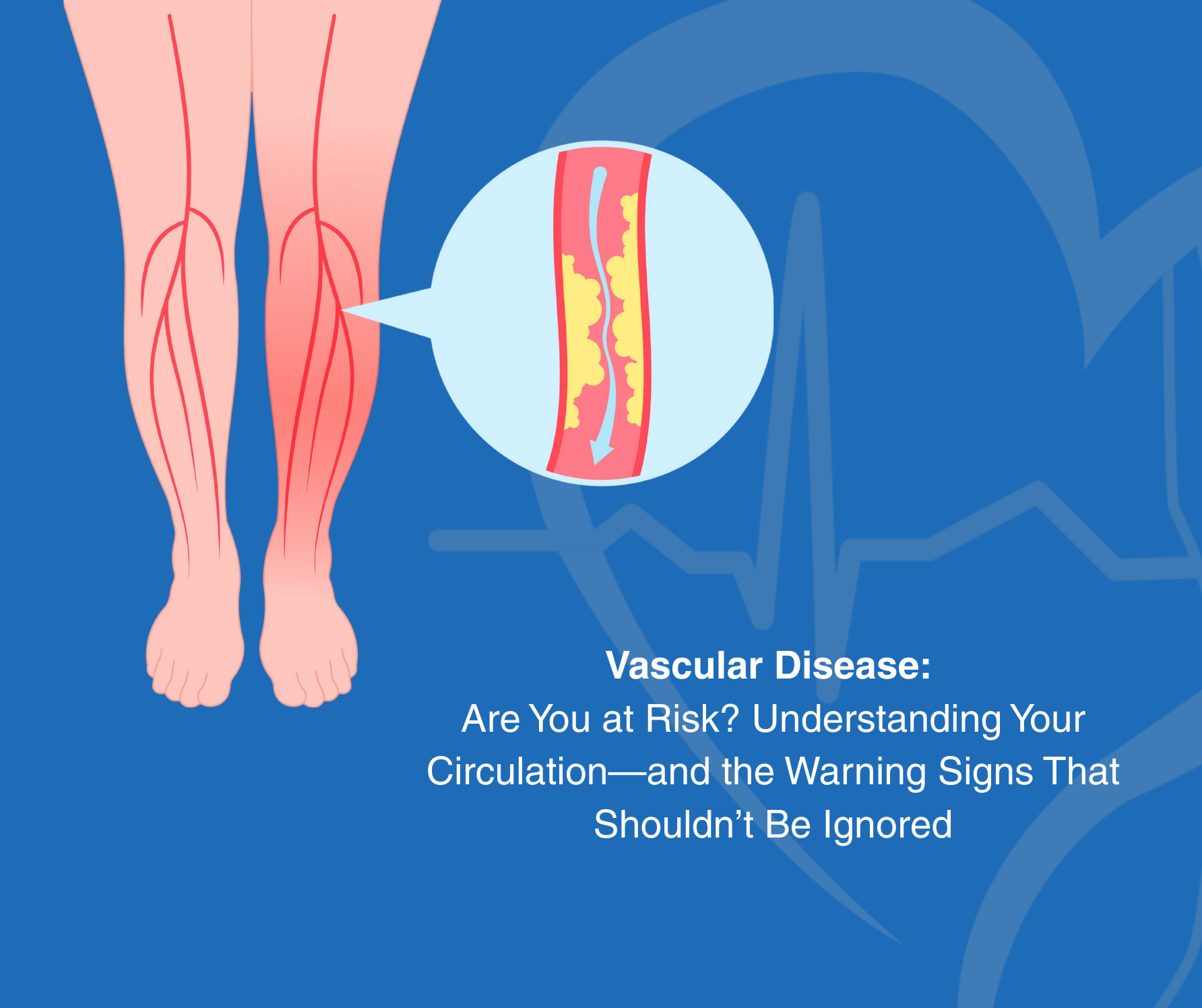 Vascular Disease Are You at Risk