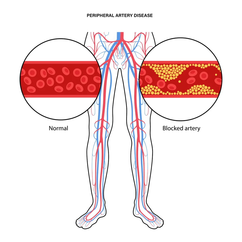 Peripheral Artery Disease: The Overlooked Form of Heart Disease