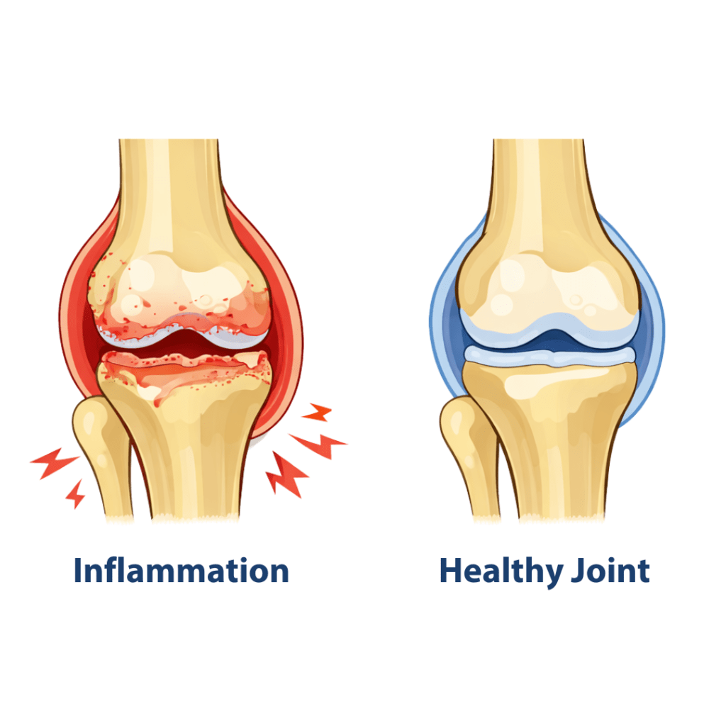 knee joint inflammation diagram showing abnormal blood vessel growth linked to chronic pain