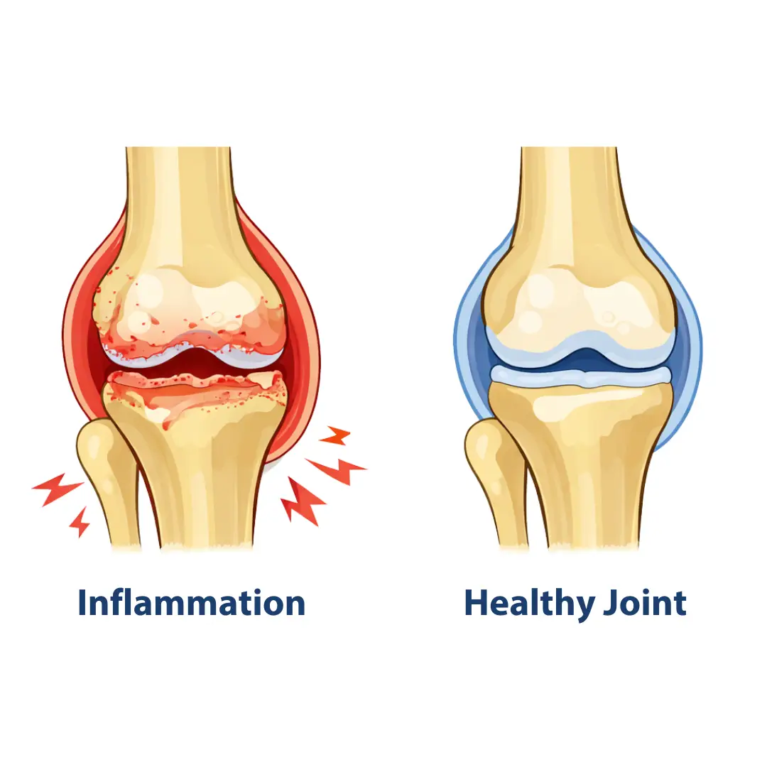 knee joint inflammation diagram showing abnormal blood vessel growth linked to chronic pain
