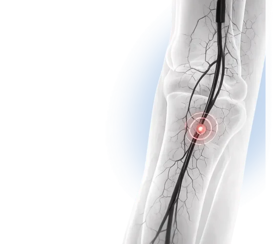 Angiogram