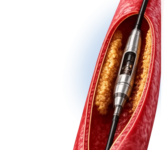 Atherectomy