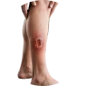 SLOW-HEALING WOUNDS